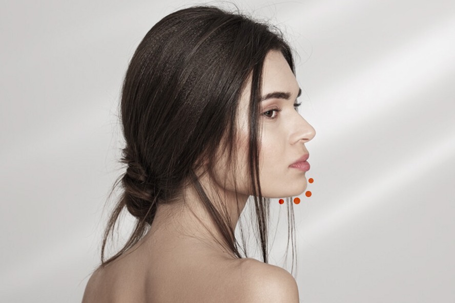 AUMENTO DE MENTÓN SIN CIRUGÍA