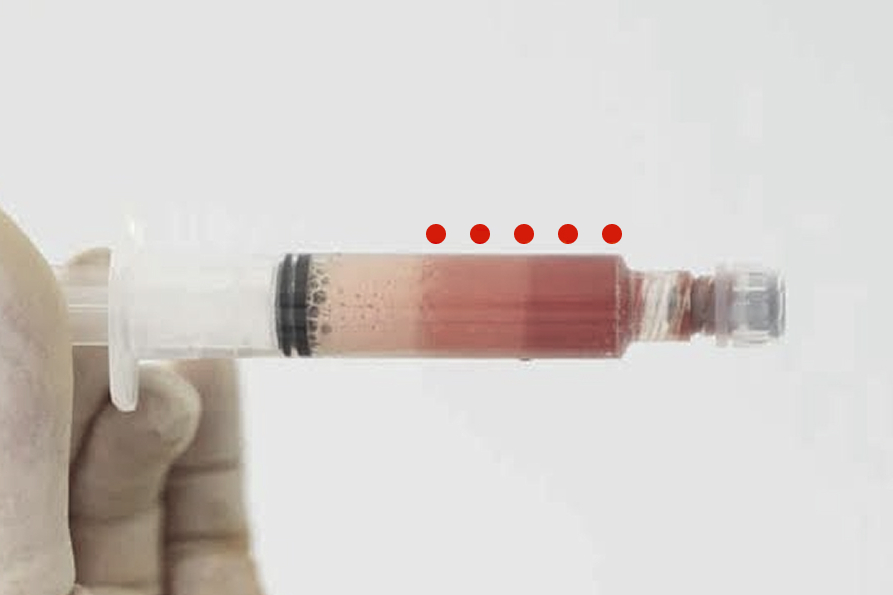 REGENERACIÓN FACIAL CON CÉLULAS MADRE MESENQUIMALES